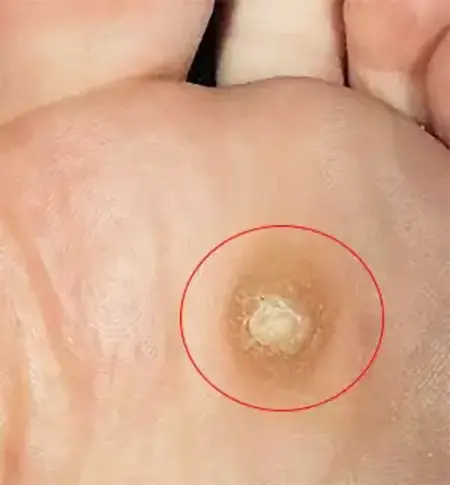 Laser Corn Removal Surgery Irvine